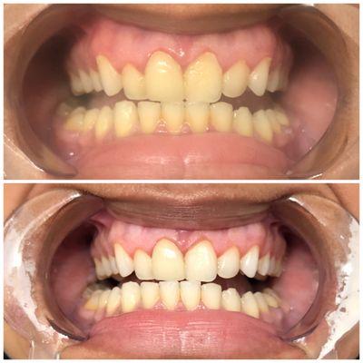 Teeth whitening results