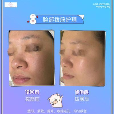 Pore treatment