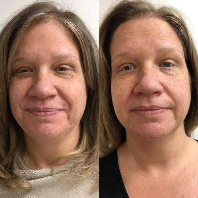 After 3 facial acupuncture treatments, her skin and face have a youthful appearance. Her skin has changed in tone and complexion.