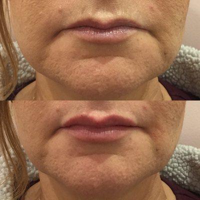 Lip Augmentation with Volbella 0.55cc