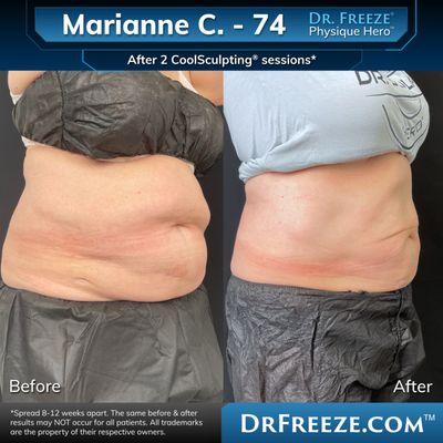 Marianne after 2 CoolSculpting sessions!