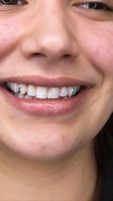 Teeth Whitening and tooth gems