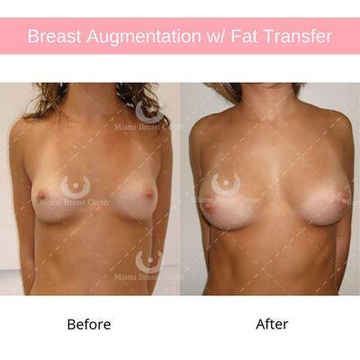 Before and after breast augmentation with fat transfer on a 20 year old woman.