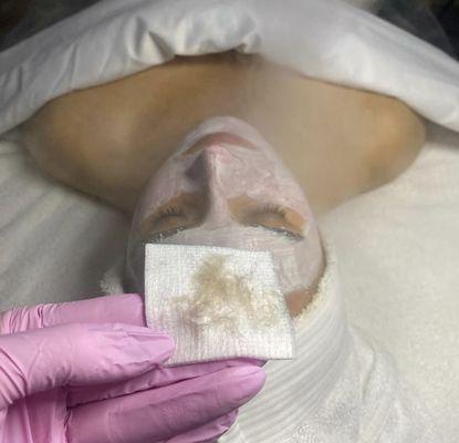 Enzyme exfoliation after dermaplaning