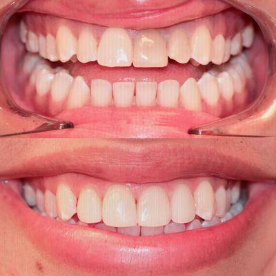 Whitening and Veneers