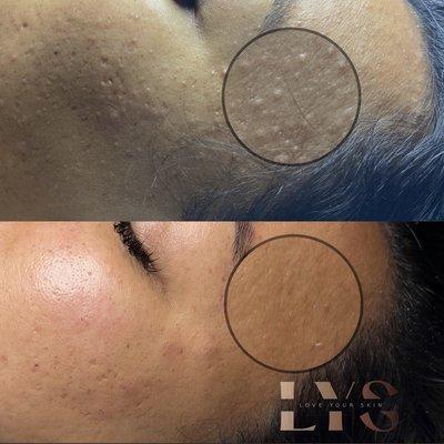 Acne bootcamp graduate- non inflamed acne before/after