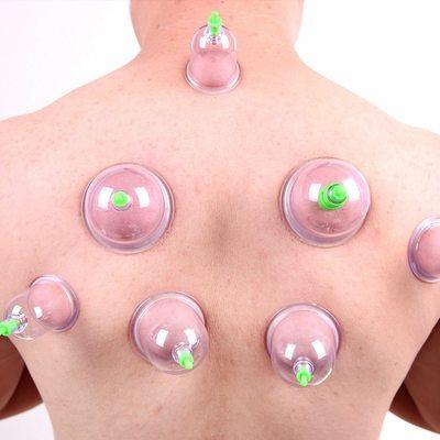 Cupping therapy for sore muscles perfect for athletes and trigger points.