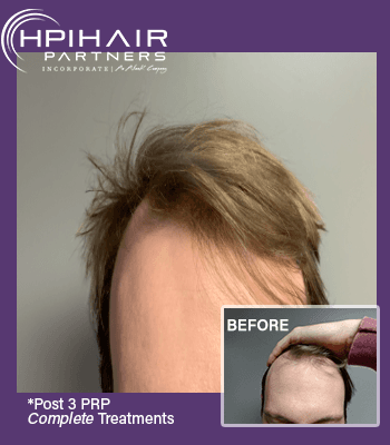 Male with androgenic hair loss + fine thin hair. His hair is now thicker, healthier post 3 PRP complete treatments + combination therapy