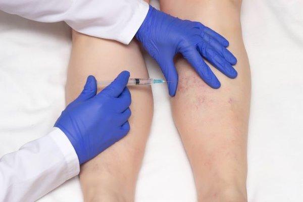 Sclerotherapy