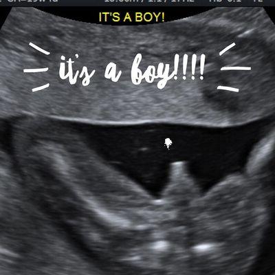 gender reveal ultrasound