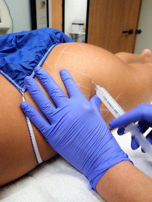 Sculptra Buttocks Injections