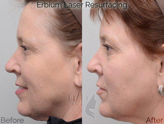 Fractional Erbium Laser Skin Resurfacing can treat fine lines and wrinkles of the face, and reverse sun damage as well.