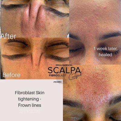 Fibroblast skin tightening on frown lines. Before and after one week.