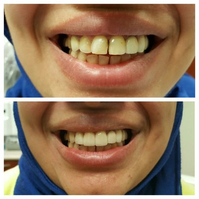 Let us help you attain that million dollar smile!! Call us today @203-691-5389