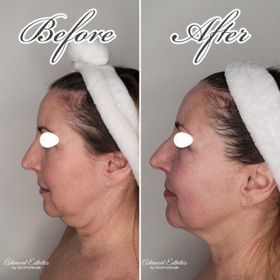 Before and after 1 Hifu skin tightening treatment second treatment before and afters coming in 60 days.