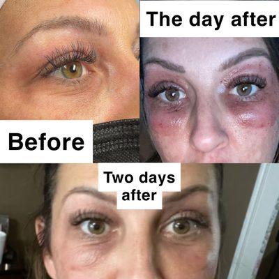 Plasma Fibroblast complete eye lift