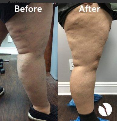 Before and After of the combination of visible veins