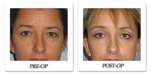 Blepharoplasty (Eyelid Surgery)