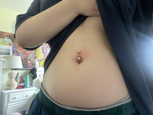 Infected navel piercing