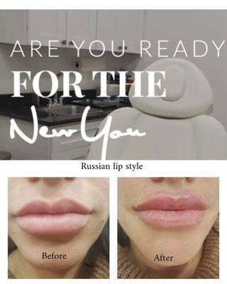 Russian style lip augmentation