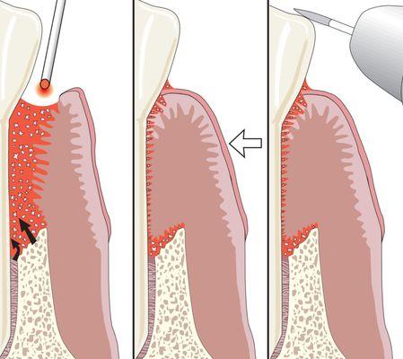 Minimally invasive laser periodontal therapy..LANAP