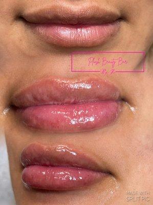 This is No Needle Lip filler!!! Results last up to 6 months 
Mother's Day special $150 ends 5/14