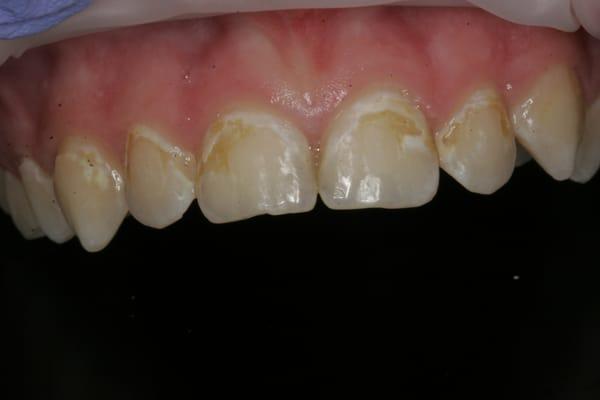 A photo of our patient after his braces were removed.