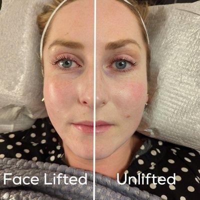 Our Non Invasive Face Lift - painless & fuss free