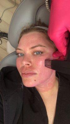 Morpheus8 RF Microneedling at Montclair