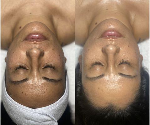 Before & After one "Transform My Skin" facial with a Chakra Balancing add-on.