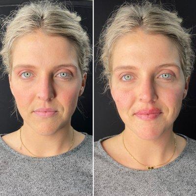 full face correction by Nina Burdett BSN-RN