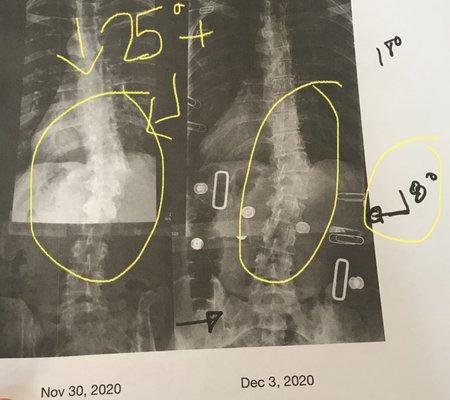 Scoliosis 3DC