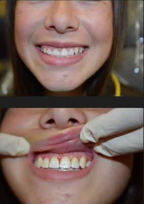 Before and after gingivectomy