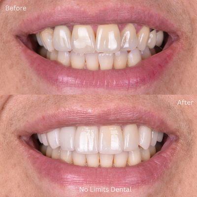 To improve this patients aesthetics and bite Dr. Rodriguez completed invisalign and 10 all porcelain crowns for this patient.