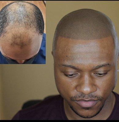 45% balding area before and after