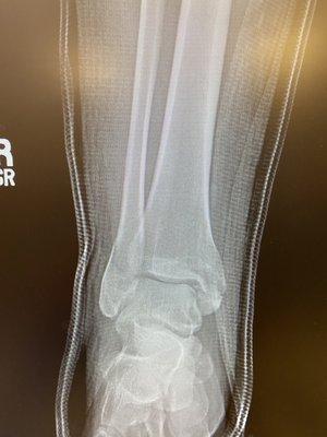 Dr Amsalem's crazy good reduction of my fracture