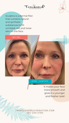 Before and After Sculptra Procedure. This filler lasts up to 12 months or more.