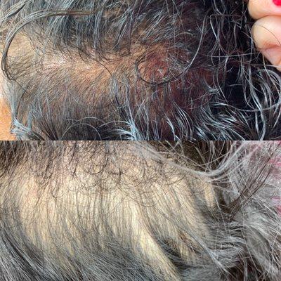 Scalp Pigmentation For Hair Loss