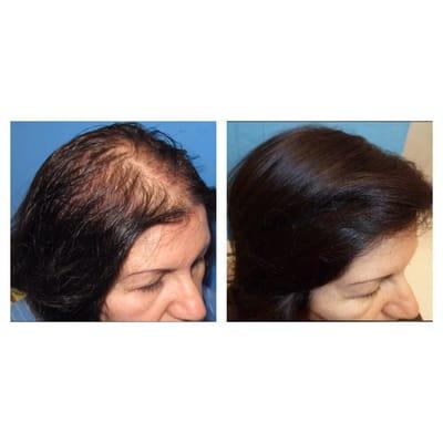 2000 grafts using FUT hair transplant technique