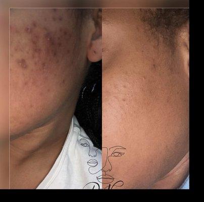 Acne Bootcamp Results