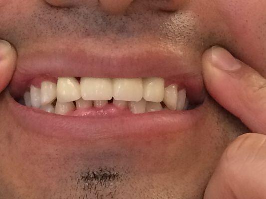 My husband's teeth after he got a smile design at 82nd Dental