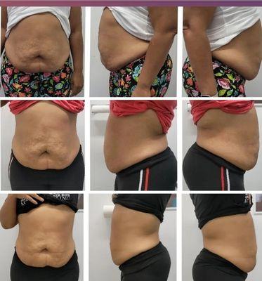 Successful client had eight treatments of Laser Lipo. Including drinking water wearing a waist trainer reduceing inches