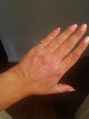 my hand after using the skin treatment for a couple months.  You can barely see the spot that people used to think was a bad burn.