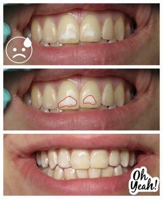 This 16yo hated the white spots on her front teeth. We gave her a conservative solution that avoided bleaching and cutting teeth! :)