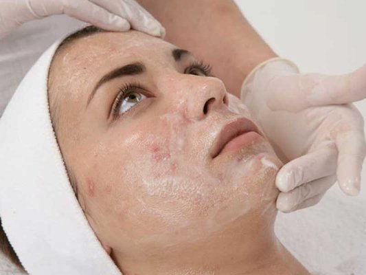 Chemical Peels