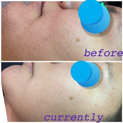 client cleared of acne within 6 months