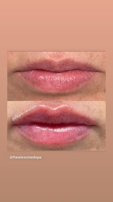 Juvederm lip filler!