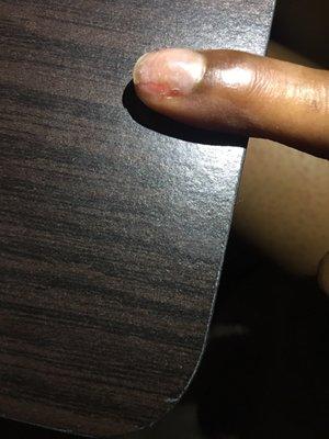 Ripped nail