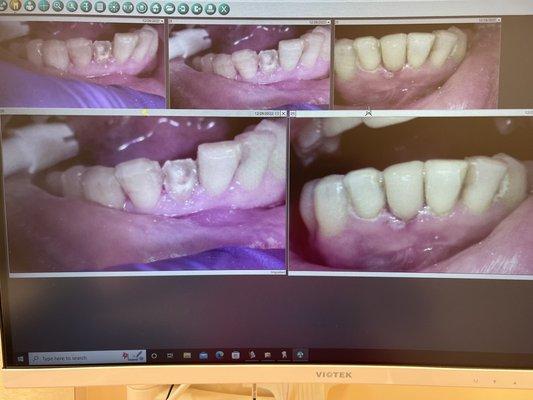 Before and after picture of the tooth.