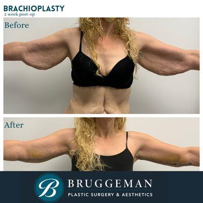 This patient had a Brachioplasty (Arm Lift) After photo is taken one week post op.